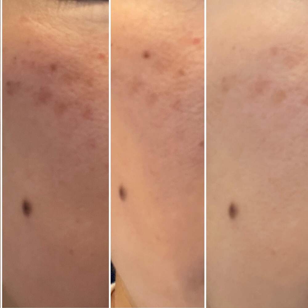 低周波シミ取り+パック&LED付1時間